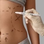 Lipoaspiração no Rio de Janeiro Definição, Indicações e Resultados Seguros