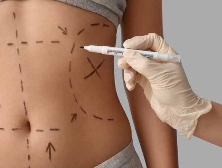 Lipoaspiração no Rio de Janeiro Definição, Indicações e Resultados Seguros